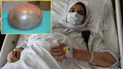 Yaşlı kadından futbol topu büyüklüğünde tümör çıkarıldı