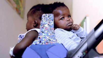 Afrikalı siyam ikizleri 18 saatlik operasyonla ayrıldı