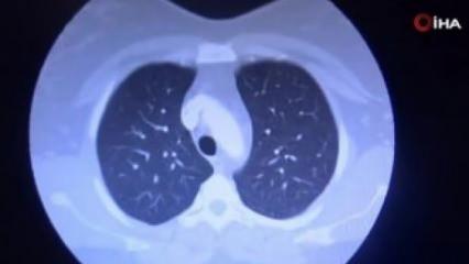 Korona virüse yakalanan hastaların ciğerlerindeki dehşet veren görüntü