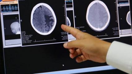 'Türk Beyin Projesi'nin tamamlanmasıyla beyin tümörü sınıflandırması yapabiliyoruz'
