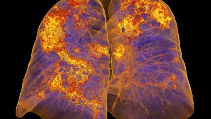 Bilim Kurulu Üyesi Turan: Virüsün akciğer hasarı inanılmaz