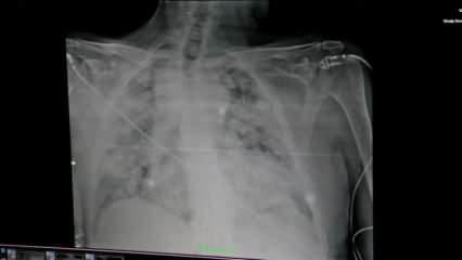 Koronalı hastaların akciğer röntgenleri korkuttu