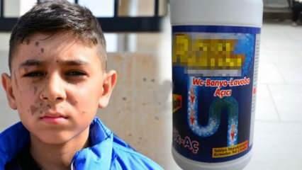 11 yaşındaki Yiğit'in yüzünü arkadaşı temizlik malzemesiyle yaktı!