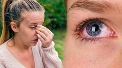 Göz alerjisine ne iyi gelir? 