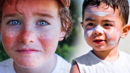 Çocukluktaki güneş yanıkları deri kanseri riskini arttırıyor!