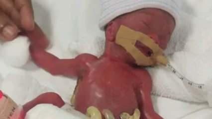 212 gram doğan bebek, 13 aylık yaşam savaşının sonunda taburcu edildi