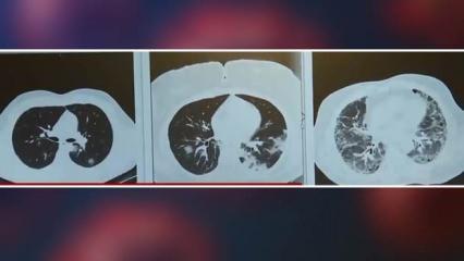 Aşılı ve aşısız hastaların farkı röntgen filminde! İşte üç Kovid hastasının akciğerleri