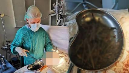 Doktorlar şok oldu! Hastanın midesinden 1 kilogramdan fazla çivi, vida ve bıçak çıkarıldı