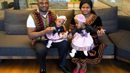 Kamerunlu yapışık ikizler Türkiye'de ayrıldı