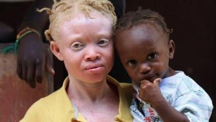 Albinoslar büyü ve batıl inançlar yüzünden tehdit altında