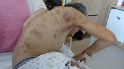 Köpek saldırısına uğramıştı! 9 operasyon geçirdi ama yetmedi