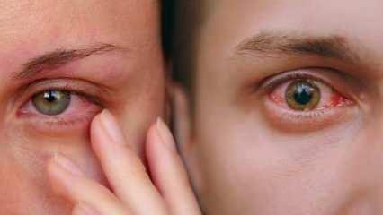 Halk arasında kırmızı göz hastalığı olarak biliniyor: Konjonktivit salgını