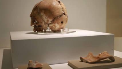 Dünya’nın ilk beyin ameliyatı Aksaray’da yapıldı! Tam 10 bin 500 yıl önce