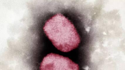 Brezilya'daki ilk maymun çiçeği virüsü hastası: Vücudumda 60'tan fazla yara saydım