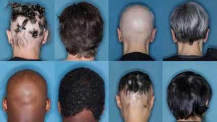 FDA onaylı ilk saç dökülmesi ilacı, hastaların yarısında saç çıkmasını sağlıyor