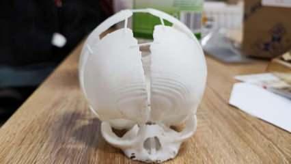 Kafatası olmadan doğan bebeğin hayatını 3D yazıcıyla üretilen kafatası kurtardı
