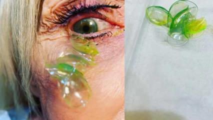 ABD'de hastanın gözünden 23 kontakt lens çıkarıldı
