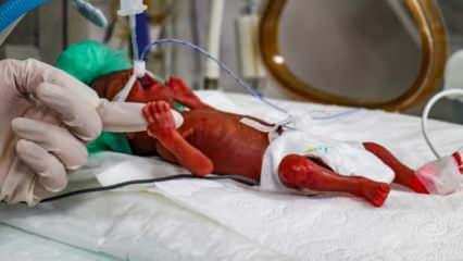 Doğumuna daha aylar vardı! 400 gram parmak bebek hayat savaşı veriyor