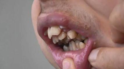Alt çenesi yok, dişleri üst damağında: Ameliyat için yardım bekliyor