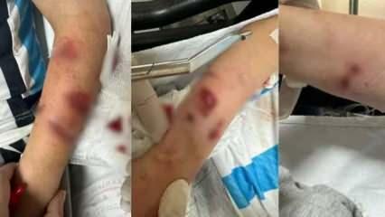 Rize'de sokak köpeklerinin saldırısına uğrayan çocuk yaralandı