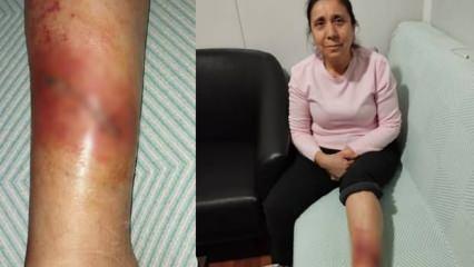 Hatay'da köpek saldırısına uğrayan kadının bacağında yarık oluştu