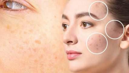 Y&uuml;zdeki g&uuml;neş lekesine kesin &ccedil;&ouml;z&uuml;m! G&uuml;neş lekesi nasıl ge&ccedil;er?