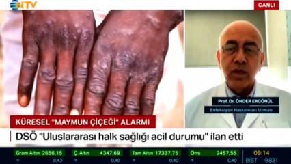 Maymun Çiçeği Virüsü alarmı! Türkiye'de görüldü mü? Prof. Dr. Ergönül: Tek tük vakalar...