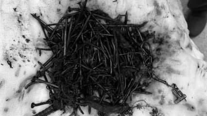 İnanılması güç olay! Midesinden 1 kilo metal çıktı