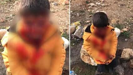 Adıyaman'da başıboş köpek dehşeti: 9 yaşındaki çocuk ağır yaralandı 
