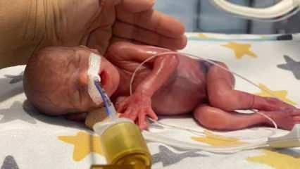 380 gram doğan parmak bebek hayata mucizevi şekilde tutundu