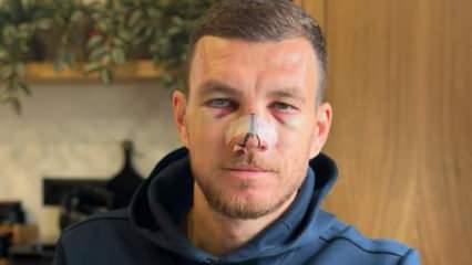 Burnu kırılan Edin Dzeko son halini paylaştı