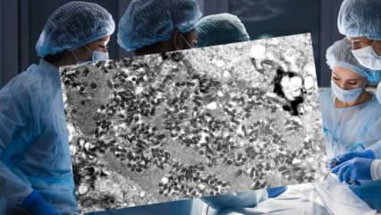 ABD'de bağışlanan organdan kuduz kapan adam öldü