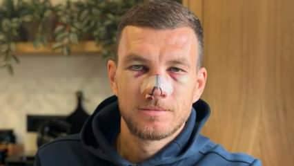 Burnu kırılan Edin Dzeko ameliyat edilecek mi?