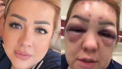 Kahramanmaraş'ta botoks yüzünden yüzü şişti, tanınmayacak hale geldi