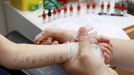&Ccedil;ocuklarda alerji testi nasıl yapılır? Deri prick testi nedir?