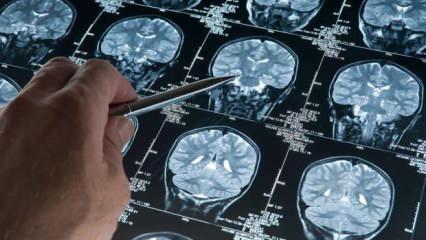 Alzheimer teşhisinde çığır açan gelişme: Yüzde 95 doğrulukla erken teşhis imkanı