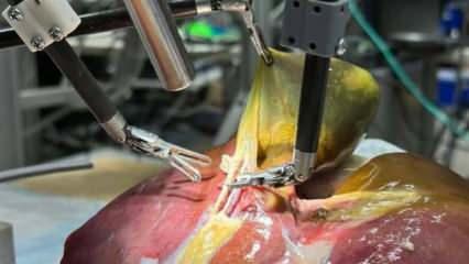 Ameliyatlar değişiyor! Tarihte ilk kez bir robot, yardım almadan gerçekleştirdi!