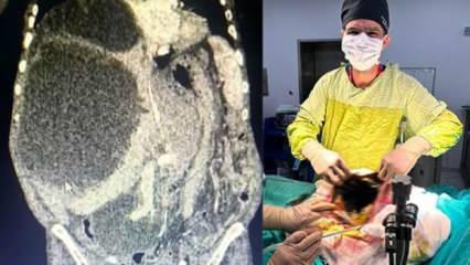 Doktor şaştı kaldı: Dünya literatüründe yok! 90 santimetrelik kedi-köpek kisti çıkarıldı!