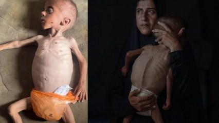 İsrail'in açlık silahı... Gazze'de 40 binden fazla bebek ölüm riskiyle karşı karşıya