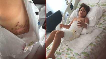 Nevşehir'de düğün faciası! Vücudu donan Elif, 7 operasyon geçirdi
