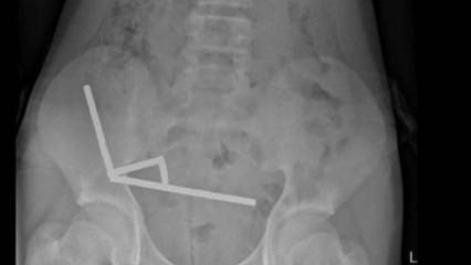 200 mıknatıs yuttu, bağırsaklarının bir kısmını kaybetti