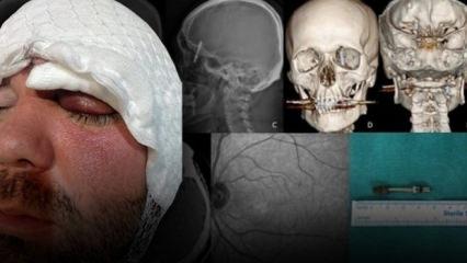 Diş tedavisi için gitti hayatı kâbusa döndü! Çenesini delip kafatasına saplandı