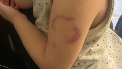 Öğrencisinin kolunu ısırdığı iddia edilen öğretmenin savunması ortaya çıktı 