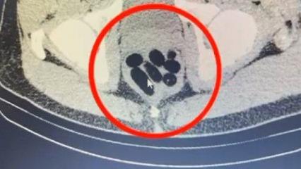 Kayseri'de uyuşturucu operasyonu: Midesinden çıkan şoke etti