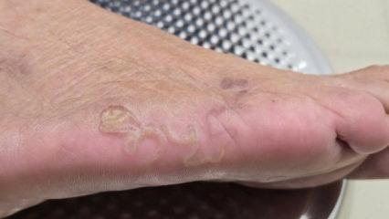 Çıplak ayak gezmek bile yasakalanmıştı: Rize’deki bu hastalık 1980’den beri görülmedi