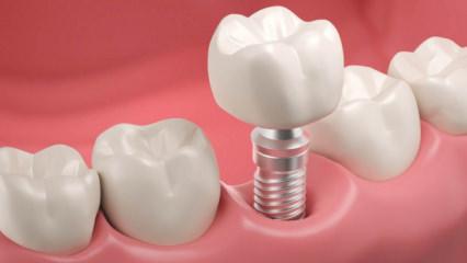 MHP'den milyonları sevindiren kanun teklifi: İmplant SSK kapsamına girebilir