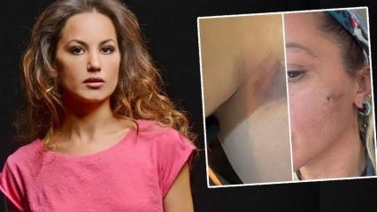 Yıldız Asyalı, 7 aylık eşi Mustafa Semih Demirci tarafından darp edildiğini açıkladı