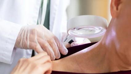 Cilt kanseri riskini 3 kata yakın artırıyor! Pop&uuml;ler diye yapmayın