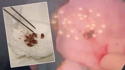 Yıllarca fark etmedi, estetik ameliyatta ortaya &ccedil;ıktı: Burunda rinolit şoku!