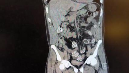 Fas&rsquo;tan Beşiktaş'a midesinde uyuşturucu getirdi: Ameliyatla &ccedil;ıkarıldı 